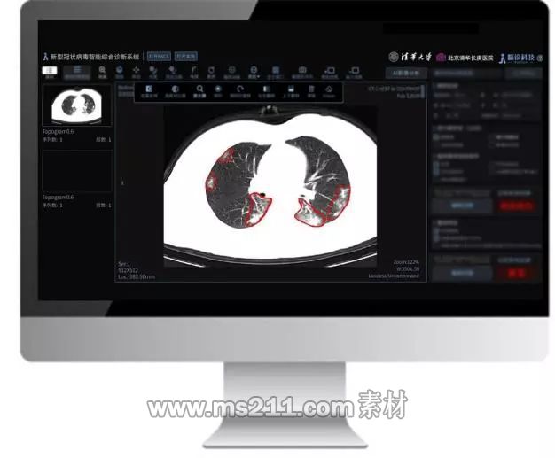 “新型冠状病毒肺炎智能辅助诊断系统”演示界面。清华大学供图